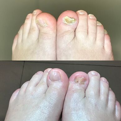 Esperienza nell'uso di barnabas di crema promicita da Israele, foto prima e dopo