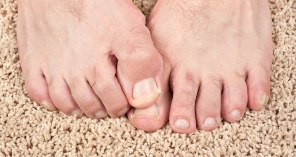 Sintomi di funghi unghie