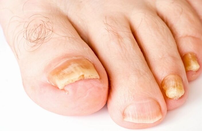 Il fungo sul pollice della gamba