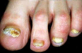 Caratterizzazione della malattia