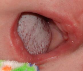 Localizzazione della malattia con un fungo