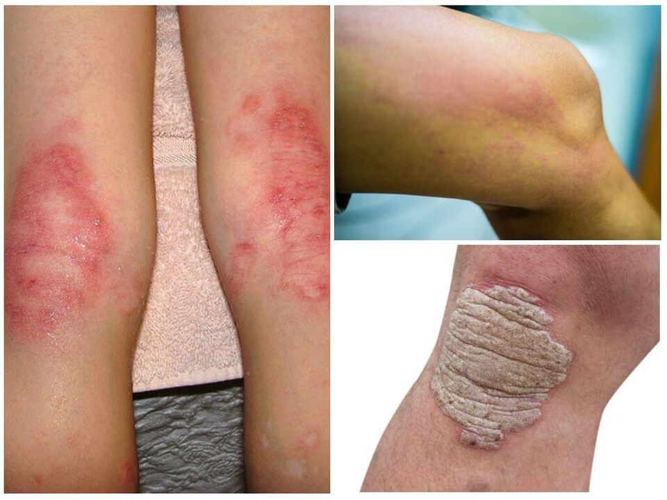 Infezioni fungine delle ginocchia