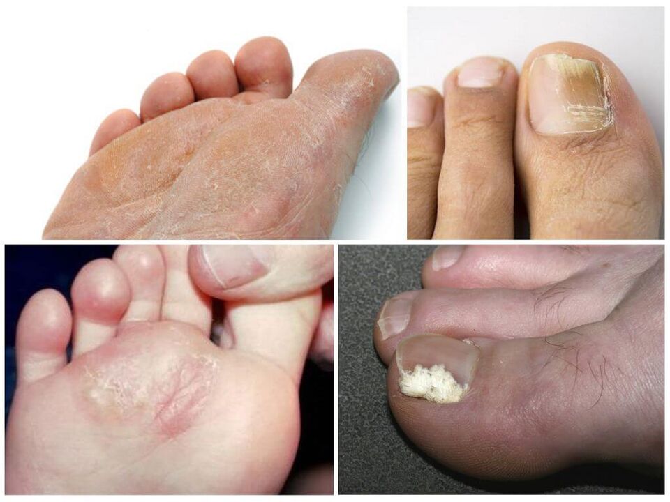 La fase iniziale del fungo del piede