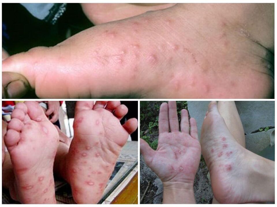 Lesioni ipercheratosiche dei piedi