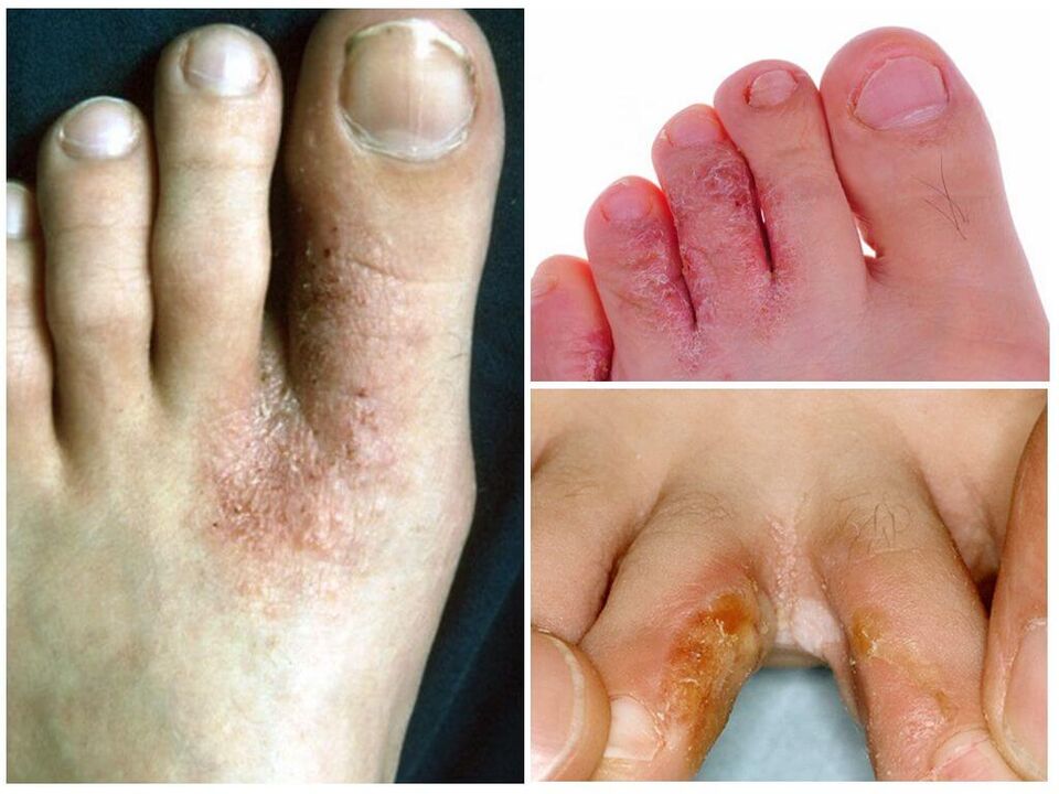 Micosi interdigitale
