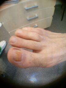 fase iniziale del fungo dell'unghia dell'alluce