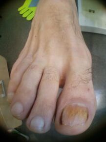 fungo dell'unghia dell'alluce