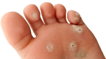 seconda fase dell'infezione fungina