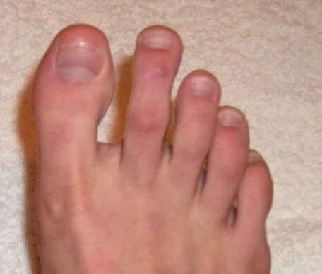 unghie dopo il trattamento laser per i funghi