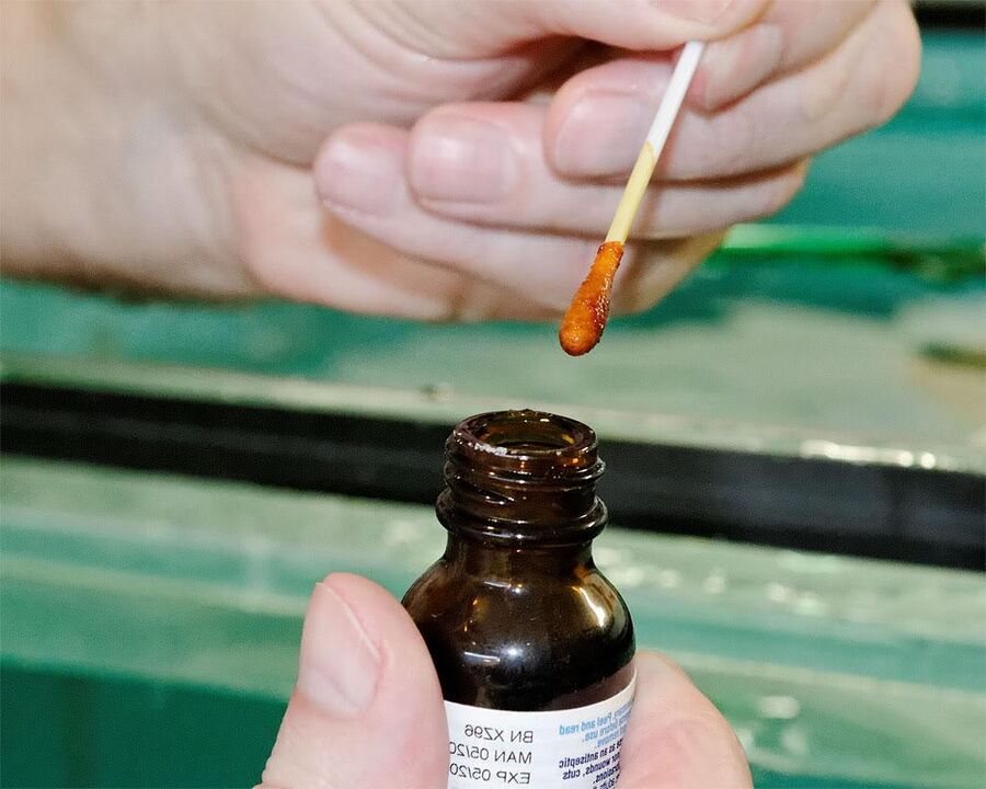 Applicare una miscela di iodio e succo di celidonia sulle unghie dei piedi eliminerà i funghi